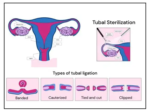 备孕必看！输卵管检查全攻略：守护“生命鹊桥”的关键一步