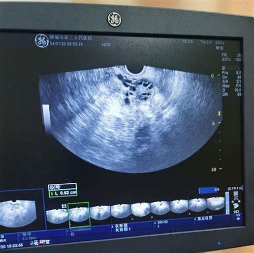 科学备孕指南：卵泡监测的重要性与实用方法解析