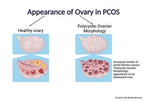 科学备孕指南：多囊卵巢综合征患者的怀孕之路